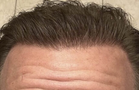 Hair Restoration case #11868