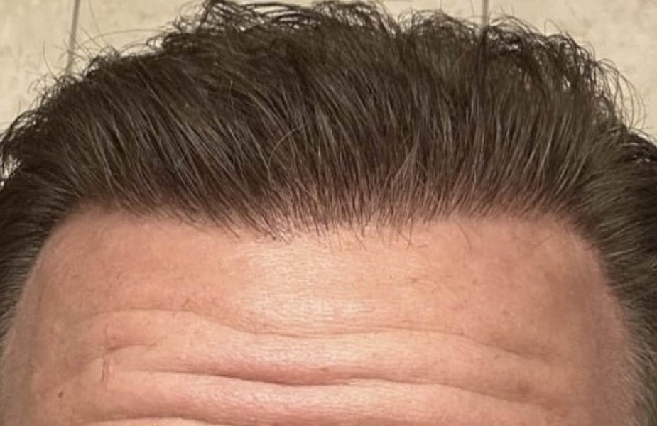 Hair Restoration case #11868