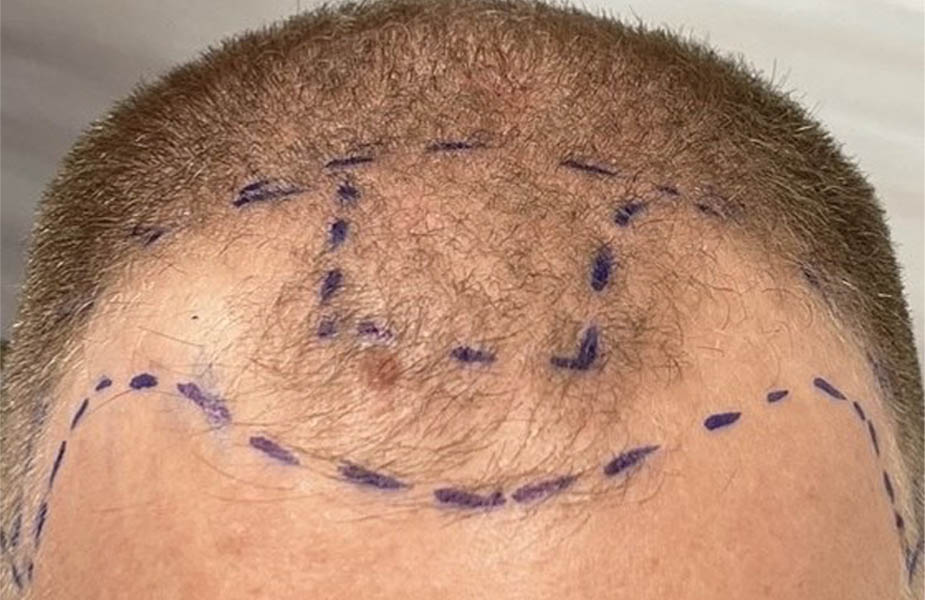 Hair Restoration case #11868