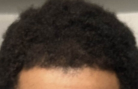 Hair Restoration case #11877