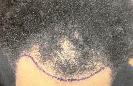 Hair Restoration case #11877