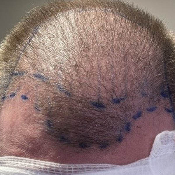 Hair Restoration case #11862