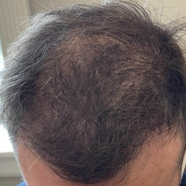 Hair Restoration case #11862
