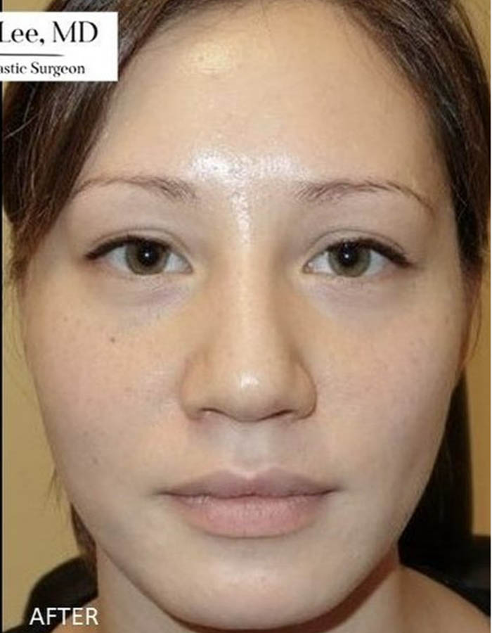 BOTOX® & Dysport case #12666