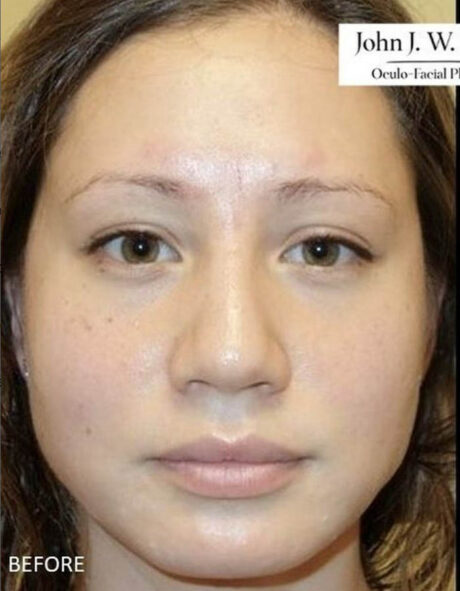 BOTOX® & Dysport case #12666