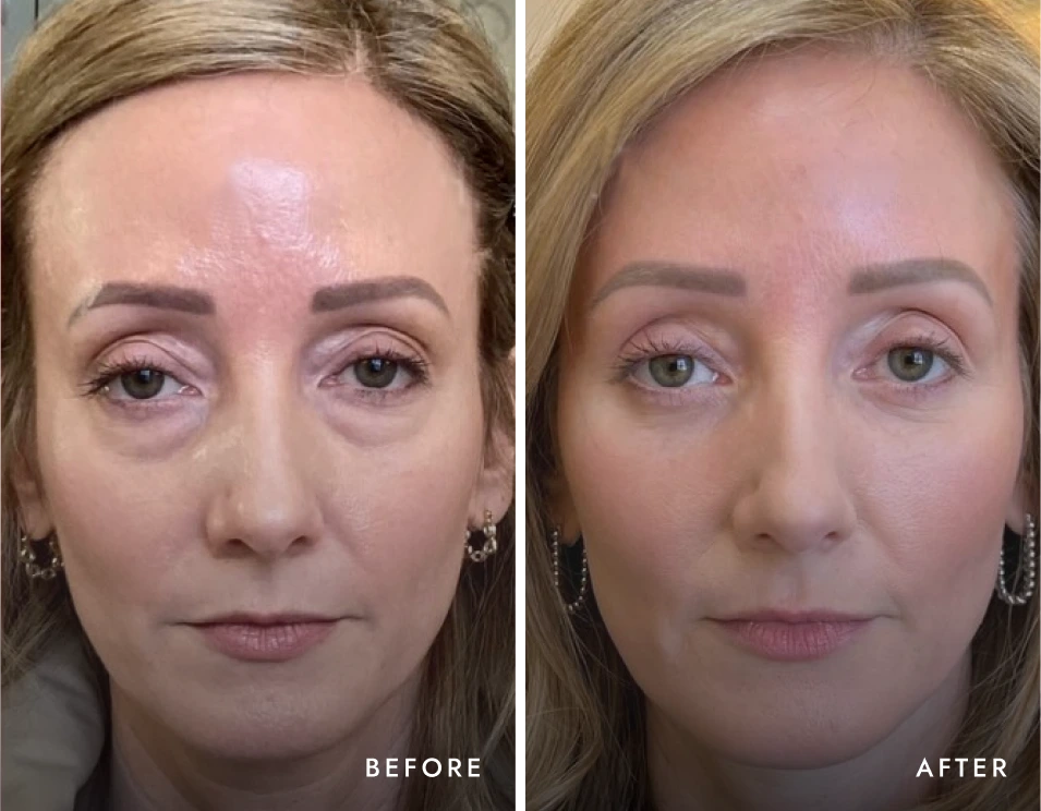 Group-2-9 lower eyelid