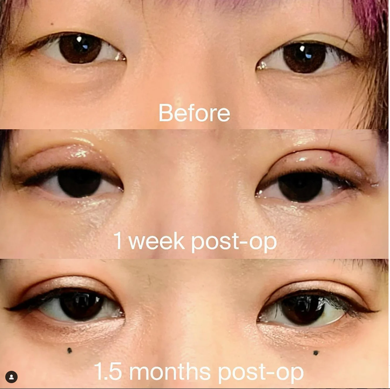 asiancrease surgery