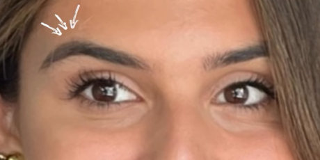 BOTOX® & Dysport case #12665