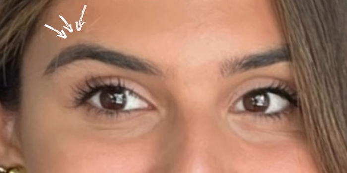 BOTOX® & Dysport case #12665