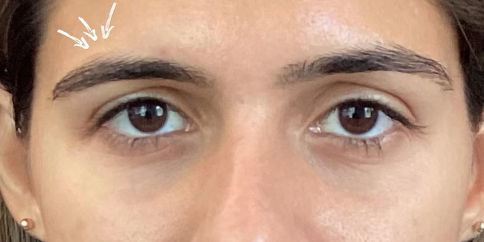 BOTOX® & Dysport case #12665