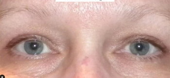 uppereyelid bxaafter