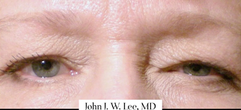 uppereyelid bxabefore