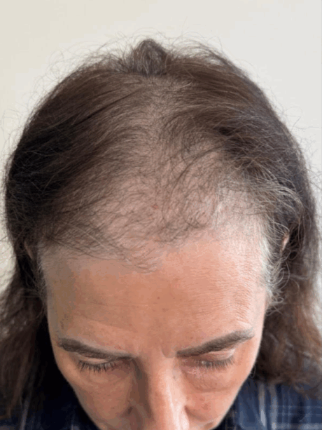 Hair Restoration case #14680