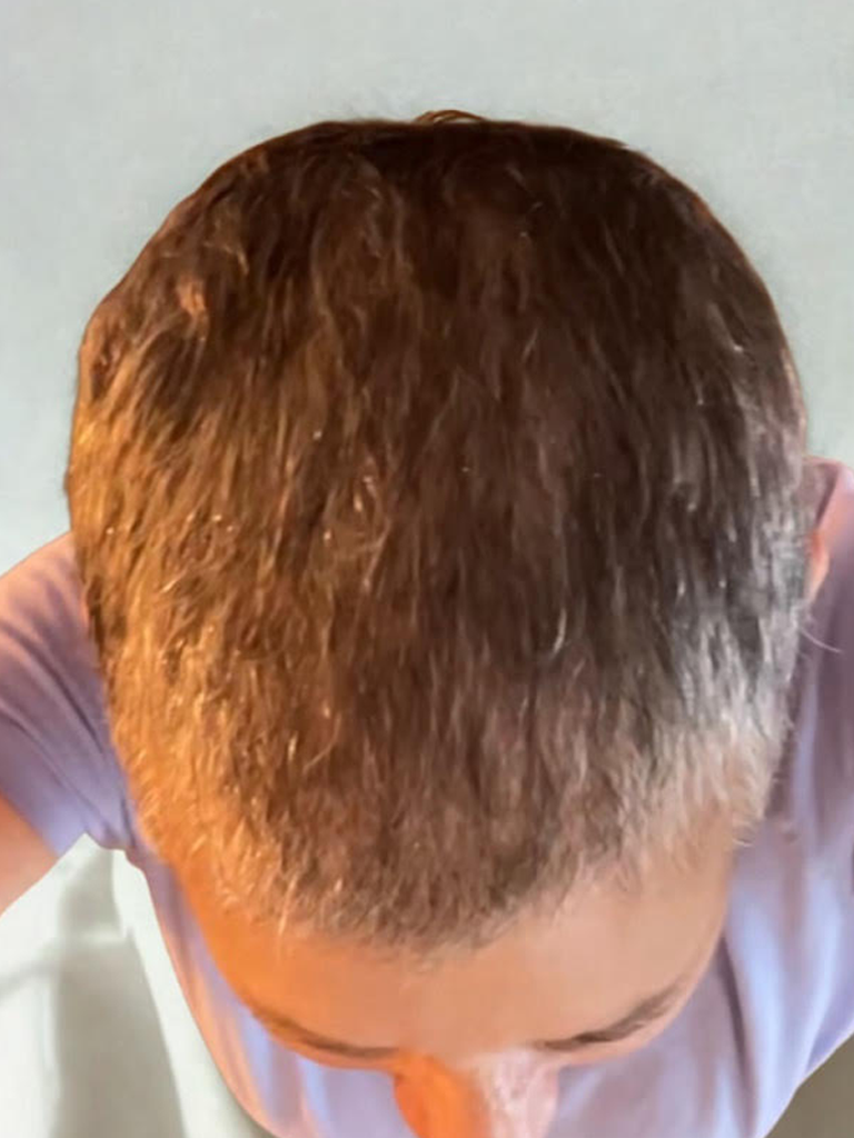 Hair Restoration case #14680